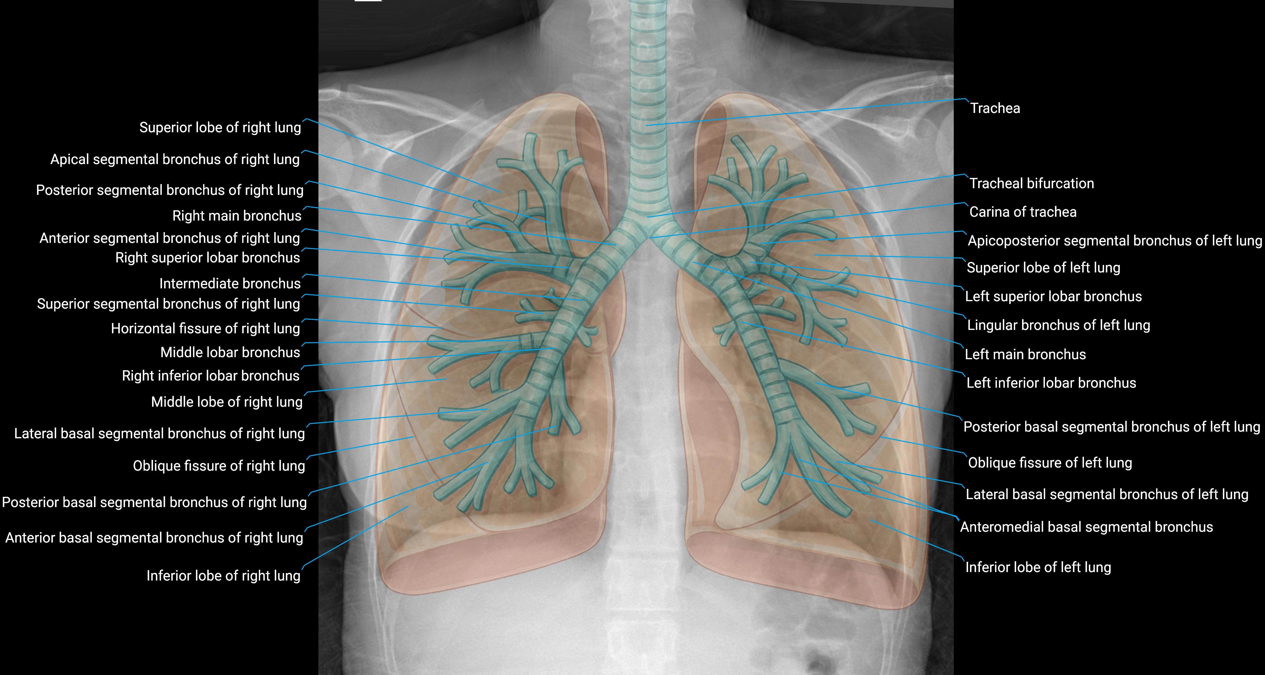 x ray chest Trachea and bronchi anatomy on chest x ray.webp